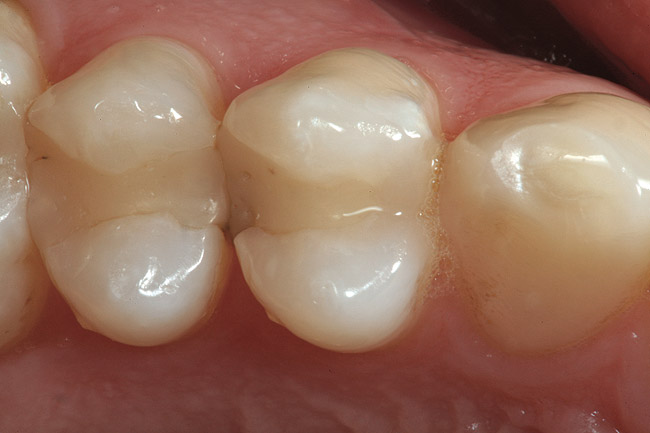 Preoperative occlusal view showing recurrent caries in the lingual-proximal area.