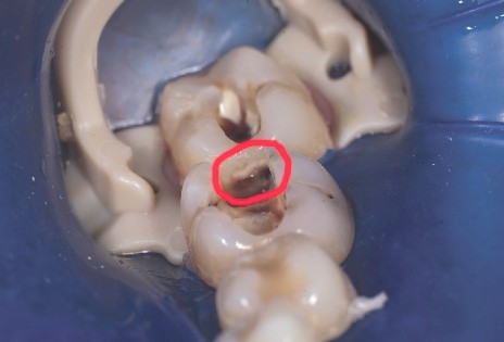Rubber dam with rubber dam clamp sits over the molars to be prepared. The rubber dam is positioned with the rubber dam clamp over the molars to be prepared, which will later be filled with composite after etching.