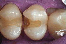 Before inserting the dental matrix, the preparation is adjusted to the premolar. 