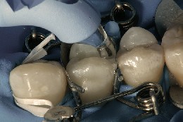 The Trimax instrument is used to press the composite onto the perfectly fitting tooth mould.