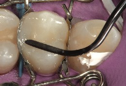 The composite filling is shaped using an instrument with a tightly fitting dental mould.