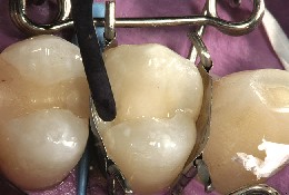 With the tooth matrix perfectly fitted to the premolar, the composite is applied and shaped with an instrument.
