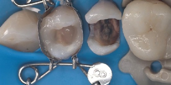 Tooth mould fits perfectly over the rubber dam on the premolar and provides a beautiful shape. The dental matrix from Dr. Walser Dental fits perfectly over the praemolar using a rubber dam and automatically creates a beautiful shape.