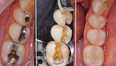 Tooth matrix ideal for composite fillings Tooth matrices from Walser are particularly suitable for composite fillings