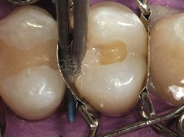 The tooth matrix fits snugly around the premolar with a perfect shape and automatically seals the cavity floor.