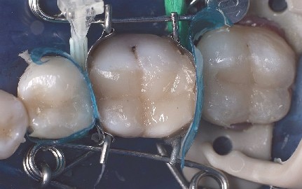 Dental mould provides beautiful shaping for composite fillings The dental mould that sits on the molar creates a beautiful shape for the composite filling.