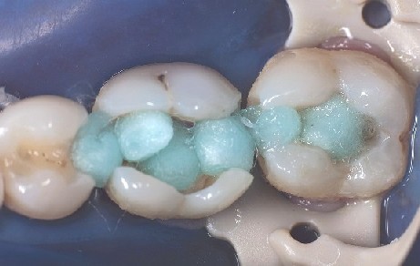 The molar cavities are disinfected and prepared for the dental matrices. The molar cavities are disinfected and prepared for the dental matrices so that the composite filling can be placed.