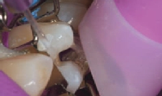 The etching gel is rinsed off the premolar and the tooth matrix.