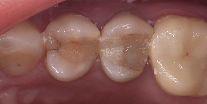 Defective fillings in two premolars that need to be removed Two defective fillings in premolars that need to be removed and replaced with new composite fillings.