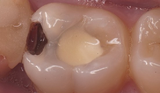 Molar von oben betrachtet und bereit zur Praeparation Ansicht des Molaren mit Kavität vor der Präparation von oben.