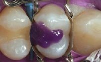 When etching gel is applied to the premolar, the perfectly fitting dental matrix creates an ideal shape on the tooth.