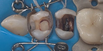 The dental mould fits perfectly over the premolar. The tooth mould fits perfectly over the premolar and automatically forms a beautiful shape for the composite filling to be inserted.