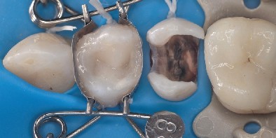 Dental matrix sits on premolar with perfect shaping of the finished composite filling The dental mould sits on the premolar with a perfect shape for the finished composite filling.