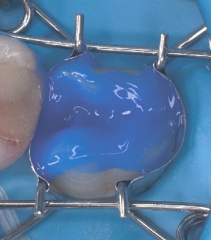 The dental matrix fits perfectly on the molar while it is being etched. The tooth matrix perfectly encloses the molar while it is being etched and automatically seals the cervical area.