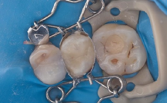 Mould for tooth fits perfectly around the premolar with attractive shaping The dental mould fits perfectly around the tooth and automatically adheres to it, resulting in optimal shaping of the filling.