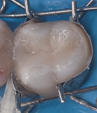 The dental mould fits perfectly on the molar and automatically forms a beautiful shape for the filling. The dental mould fits perfectly on the premolar and automatically forms a beautiful shape for the composite filling to be inserted.