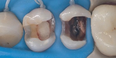 Rubber dam sits over two prepared premolars The rubber dam is secured with dental floss and sits over two prepared premolars.