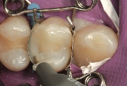 The tooth-coloured composite is placed in the premolar and in the perfectly fitting tooth mould.