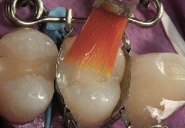 The dental mould fits perfectly on the premolar and is filled with composite, which is smoothed with the Keystone brush.