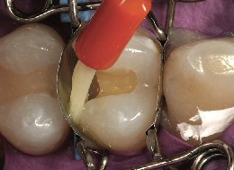 On the premolar, a brush glides along the inside of a perfectly fitting tooth mould and distributes the adhesive.