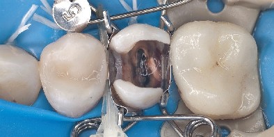 The dental matrix fits perfectly on the premolar and automatically forms a beautiful shape for the filling. The dental mould fits perfectly on the premolar and automatically forms a beautiful shape for the composite filling to be inserted.