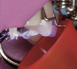 The light curing of the lingual increment is carried out using the tooth mould.