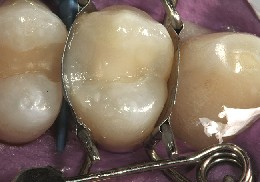 The dental mould creates a perfect shape for the finished composite filling on the premolar.