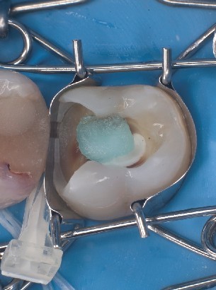Tooth mould fits perfectly on molar above rubber dam The dental matrix sits optimally over the molar above the rubber dam where the cavity is being disinfected.