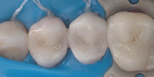 After removing the dental matrices, the perfect composite fillings are revealed. Removing the dental matrices reveals the perfect composite fillings, which have an ideal contact point.