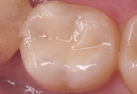 Tooth mould removed, perfect result of tooth filling After removal of the Walser dental matrix, perfect surface of the cavity