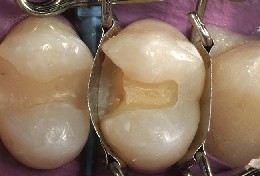 The tooth mould creates an attractive shape on the premolar and automatically seals the cavity floor against blood and saliva. 
