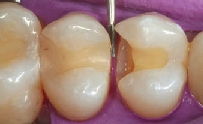 Before inserting the dental matrix, the adjacent filling on the premolar is contoured.