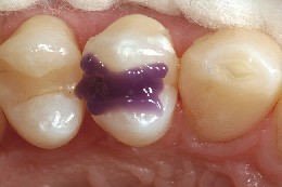 Before inserting the dental matrix, the premolar is etched with etching gel.