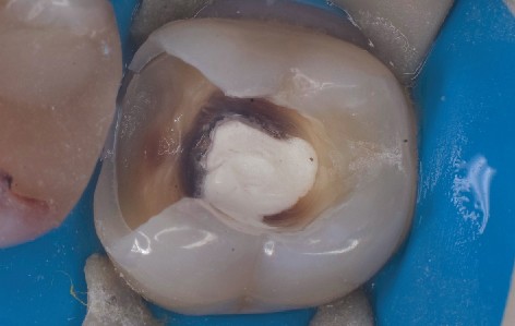 Rubber dam placed over prepared molar Rubber dam clamp secures rubber dam over prepared molar
