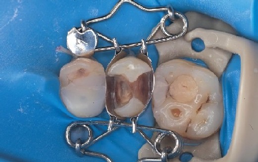 Zahn-Matrize sitzt ideal auf Praemolar und bildet automatisch schoene Formgebung der Fuellung Zahn-Matrize sitzt ideal auf Prämolar, bildet automatisch eine schöne Formgebung der Füllung und dichtet zervikal sofort ab