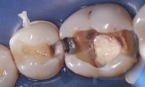 Rubber dam over premolar and molar with preparations The rubber dam is placed over the prepared premolar and molar, with the rubber dam being secured to the premolar with dental floss.