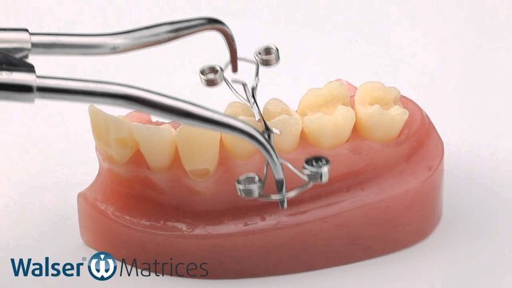 Video clip: Walser dental matrix X-shape in use