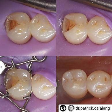 Walser dental matrix on the premolar – clinical application